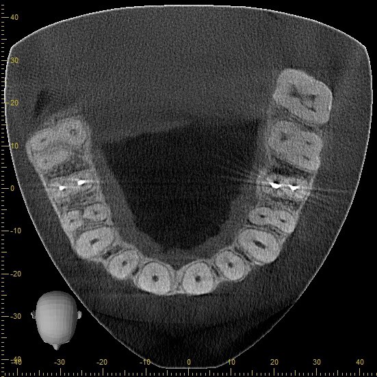 3D dental tomography scan of the lower jaw taken at a Colombian imaging center
