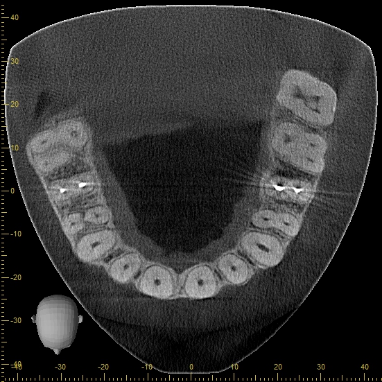 3D dental tomography scan from a Colombian dental clinic showing current diagnostic imaging